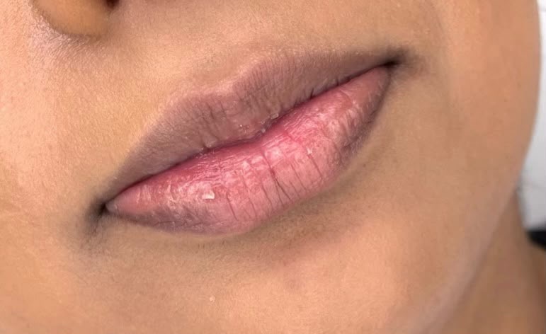 Lip treatment result